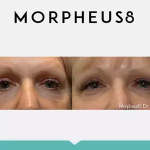 Morpheus8-eyes