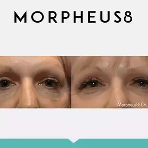 Morpheus8-eyes