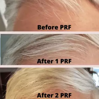 PRF HAIR RESTORATION before and after