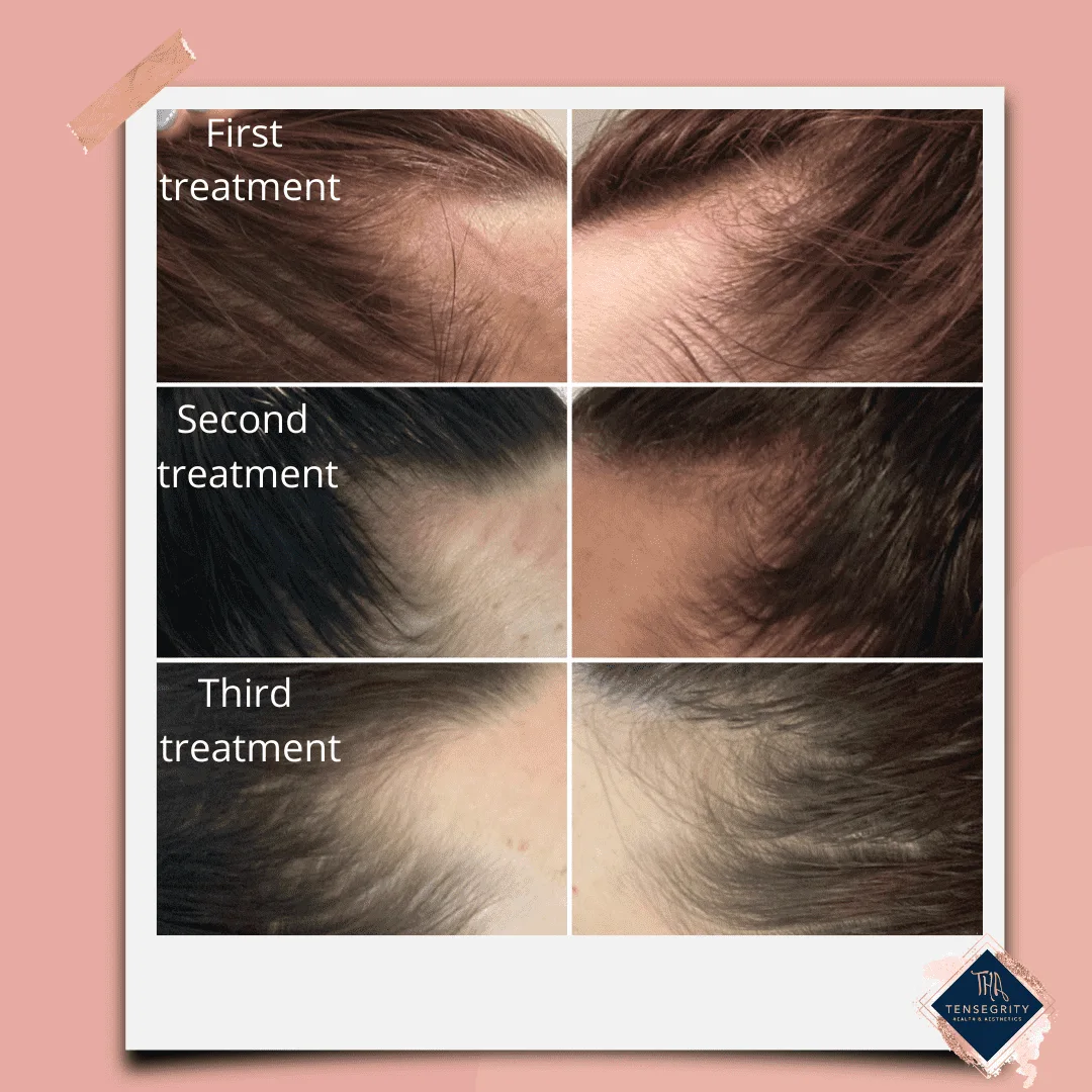 hair regrowth 4