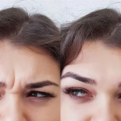BOTOX_beforeafter-tha BOTOX_beforeafter-tha