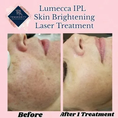 Lumecca-treatment-maine Lumecca-treatment-maine