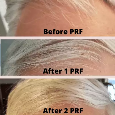 Hair Regrowth and Rejuvenation - Tensegrity Medical Spa