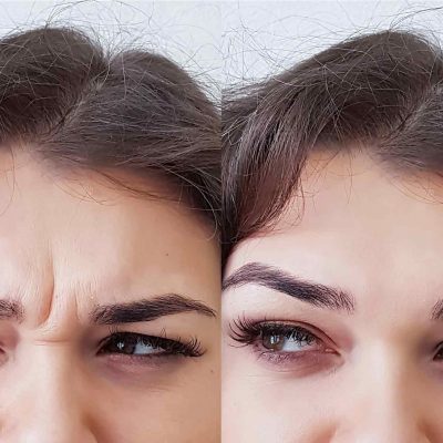 BOTOX_beforeafter-tha BOTOX_beforeafter-tha